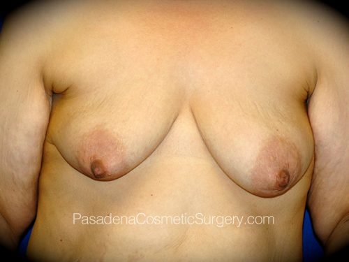 Breast Augmentation with Mastopexy Patient 12 Before