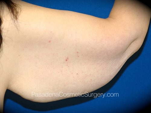 Arm Lift Patient 13 Before - 2