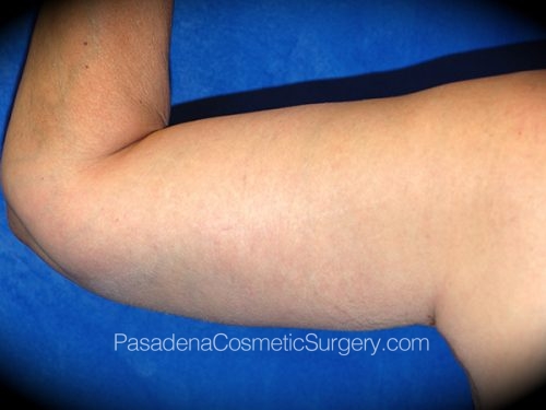 Arm Lift Patient 14 After - 2