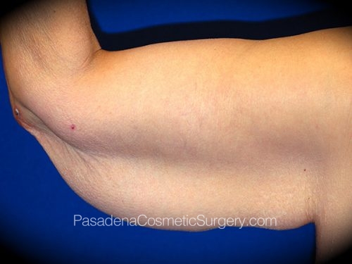 Arm Lift Patient 14 Before - 2