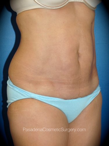 Smart Lipo Patient 01 After - 2