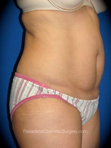 Smart Lipo Patient 01 Before - 2