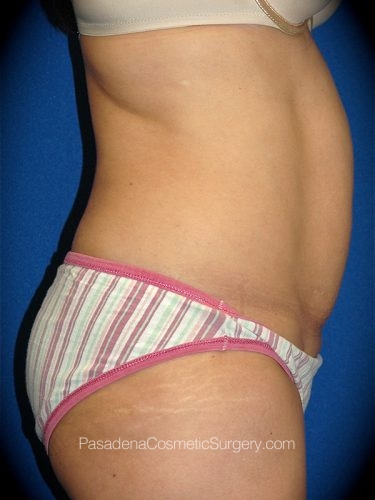 Smart Lipo Patient 01 Before - 3