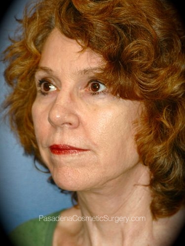 Facelift Patient 18 After - 2