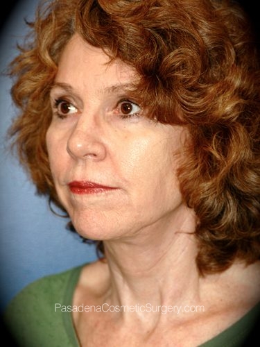 Neck Lift Patient 03 After - 2