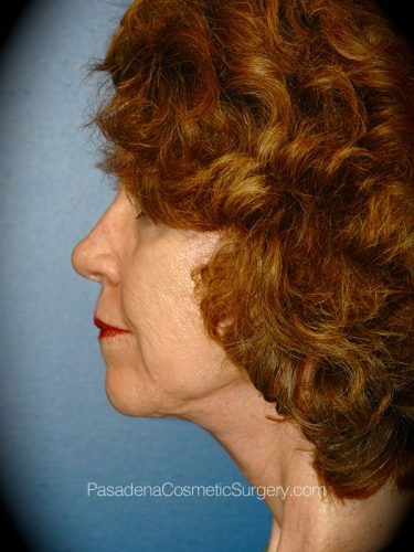 Facelift Patient 18 After - 3