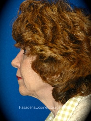 Facelift Patient 18 Before - 3