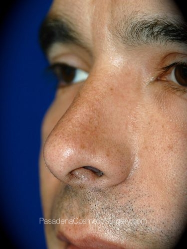 Rhinoplasty Patient 13 After - 2