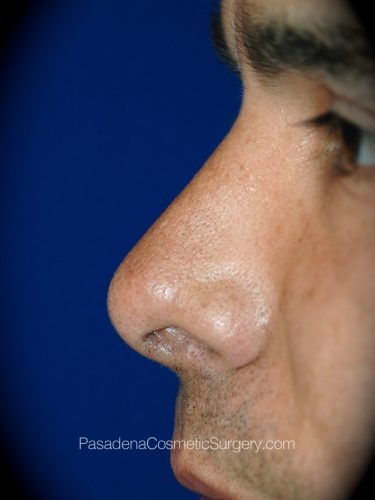 Rhinoplasty Patient 13 After - 3