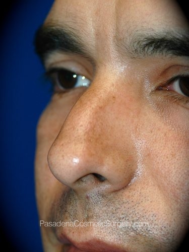 Rhinoplasty Patient 13 Before - 2