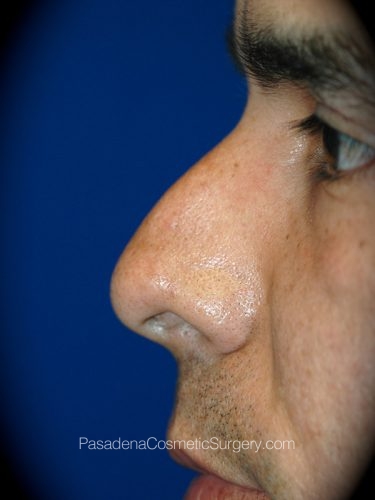 Rhinoplasty Patient 13 Before - 3