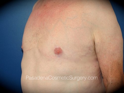 Gynecomastia Patient 05 After - 2