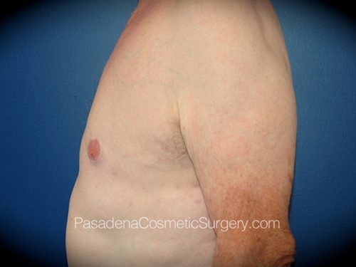 Gynecomastia Patient 05 After - 3