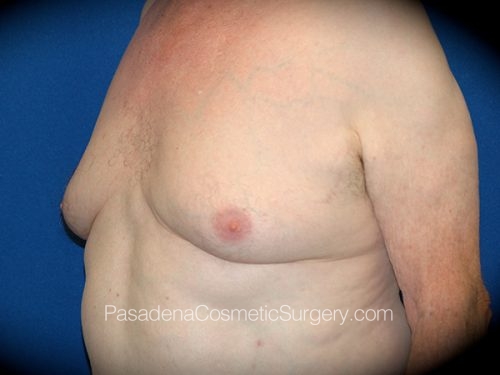 Gynecomastia Patient 05 Before - 2