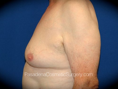 Gynecomastia Patient 05 Before - 3