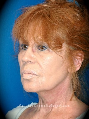 Neck Lift Patient 04 After - 2