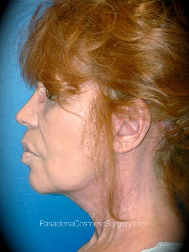 Neck Lift Patient 04 After - 3