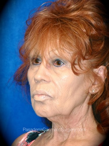 Neck Lift Patient 04 Before - 2