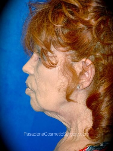 Neck Lift Patient 04 Before - 3
