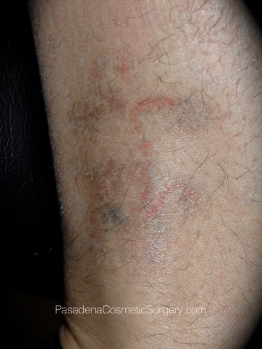 Laser Tattoo Removal Patient 03 After
