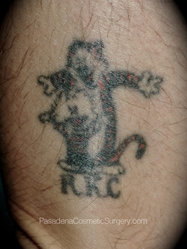 Laser Tattoo Removal Patient 03 Before