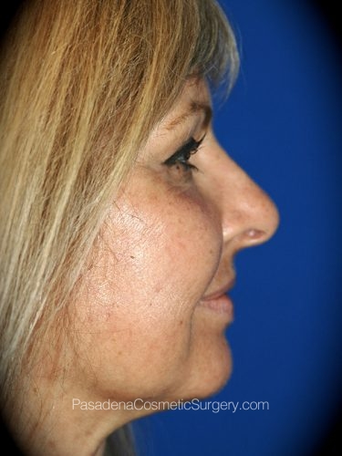 Laser Skin Resurfacing Patient 04 After - 3