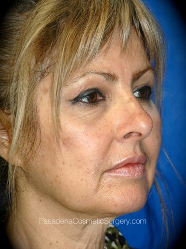 Laser Skin Resurfacing Patient 04 Before - 2