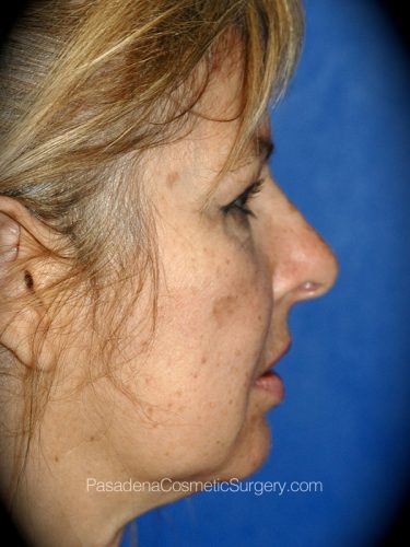Laser Skin Resurfacing Patient 04 Before - 3