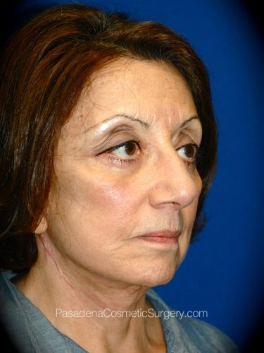 Facelift Patient 20 After - 2