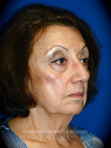 Facelift Patient 20 Before - 2