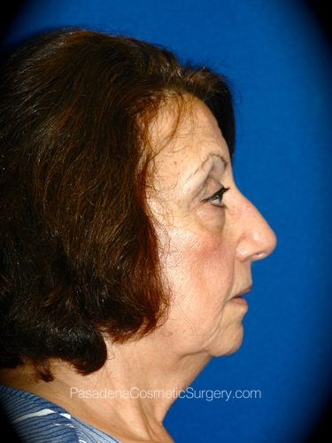 Facelift Patient 20 Before - 3
