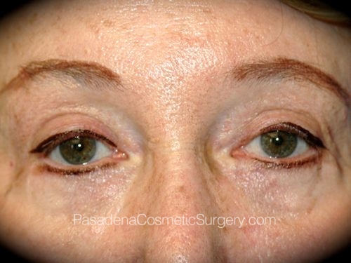 Brow Lift Patient 08 After