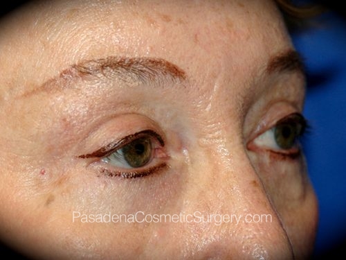 Brow Lift Patient 08 After - 2