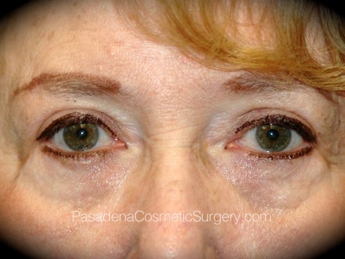 Brow Lift Patient 08 Before