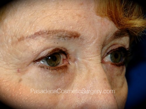 Brow Lift Patient 08 Before - 2