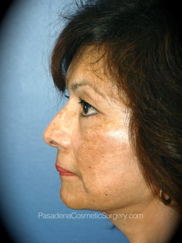 Facelift Patient 21 After - 3