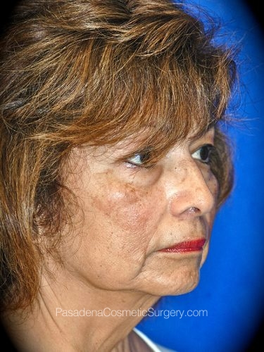 Facelift Patient 21 Before - 2