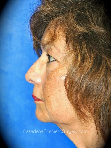 Facelift Patient 21 Before - 3