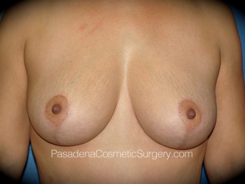 Breast Lift Patient 05 After
