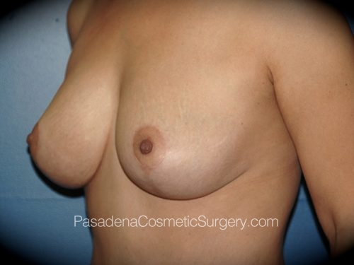 Breast Lift Patient 05 After - 2