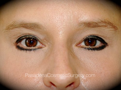 Brow Lift Patient 09 After
