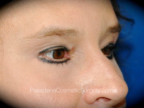 Brow Lift Patient 09 After - 2