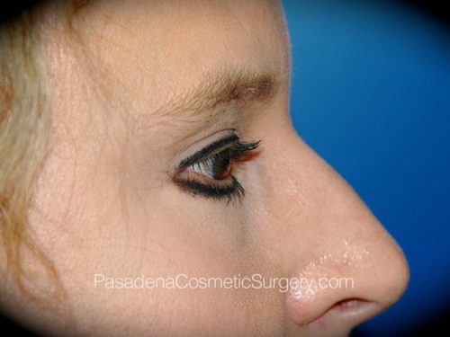 Brow Lift Patient 09 After - 3