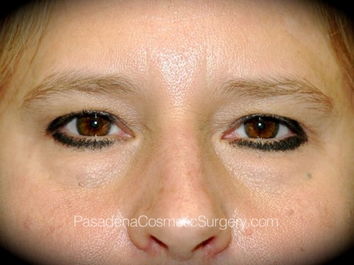 Brow Lift Patient 09 Before