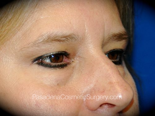 Brow Lift Patient 09 Before - 2