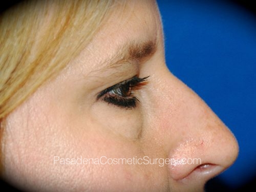 Brow Lift Patient 09 Before - 3