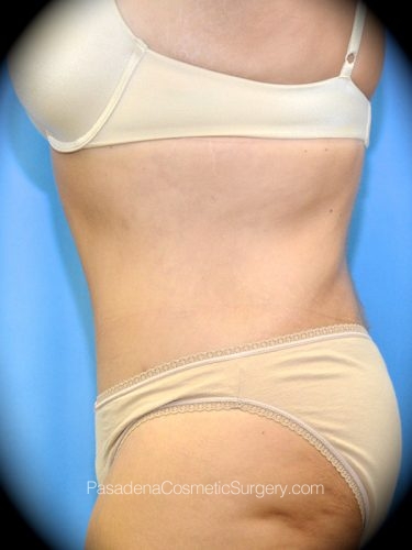 Smart Lipo Patient 02 After - 3