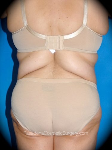 Smart Lipo Patient 02 Before