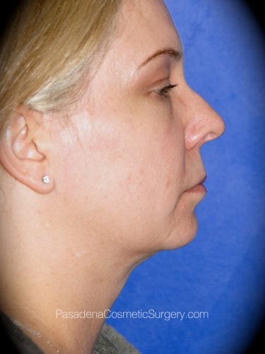 Smart Lipo Patient 03 After - 2