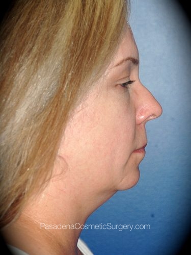 Smart Lipo Patient 03 Before - 2